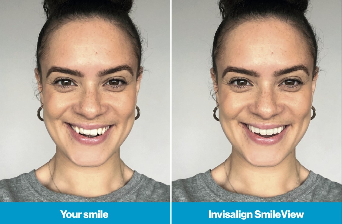 invilasignsmile